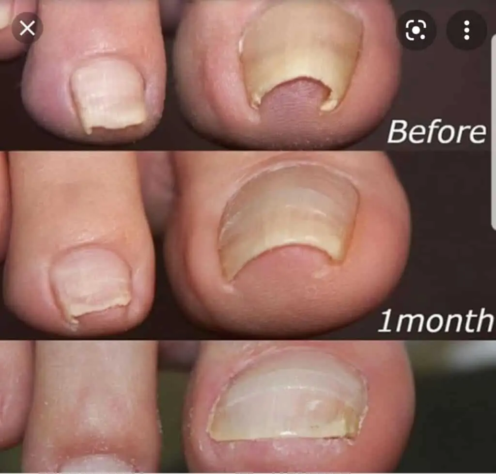 Ingrown Toe Nails, Inertia Health Group Adelaide, Physiotherapy