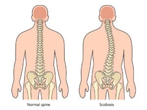 early intervention for scoliosis
