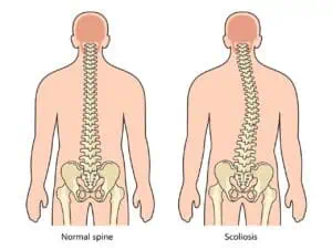 early intervention for scoliosis