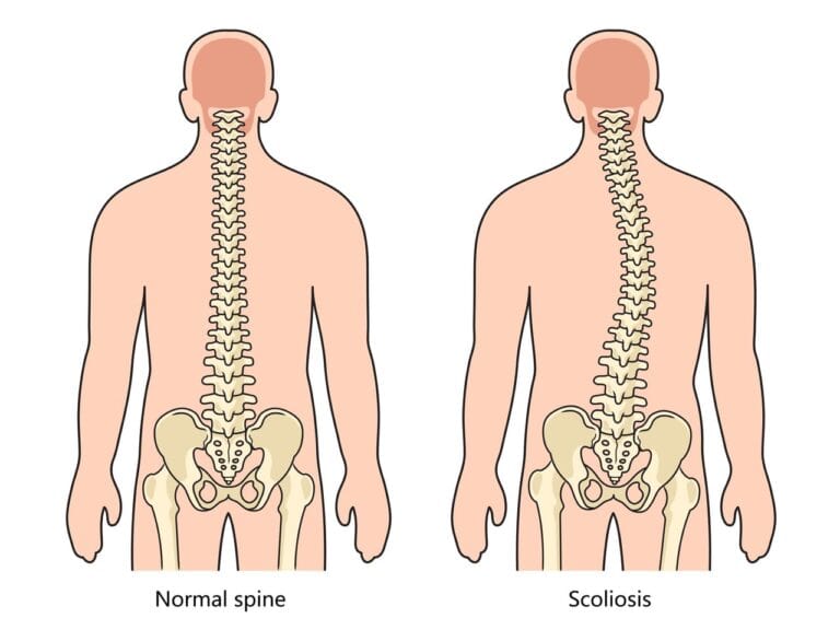 early intervention for scoliosis