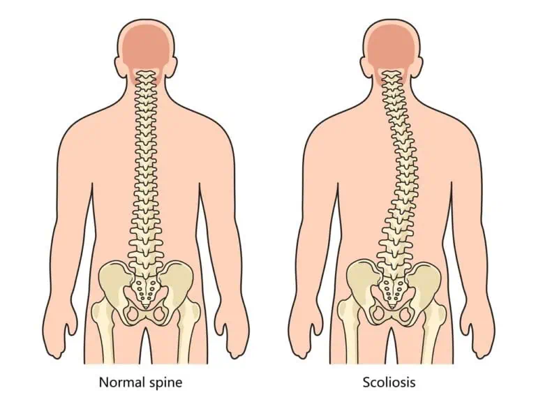 early intervention for scoliosis