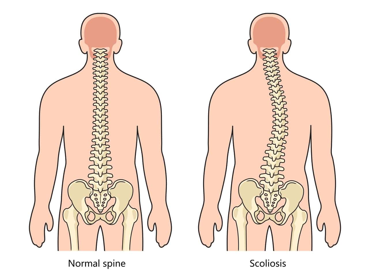 early intervention for scoliosis