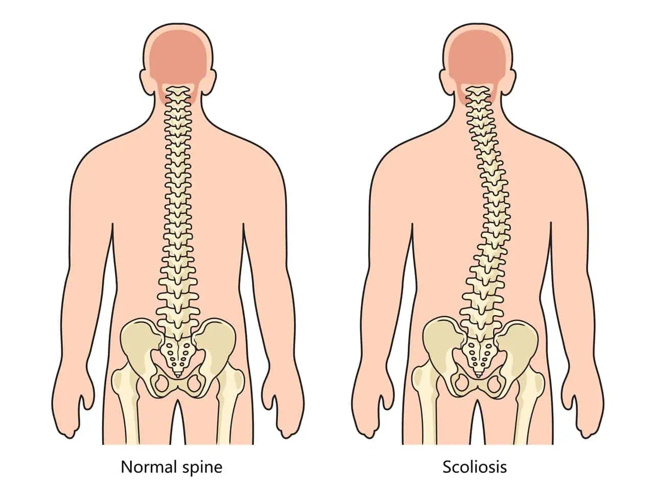 early intervention for scoliosis